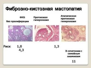 Что такое эхоскопически признаки фиброзно-кистозной мастопатии