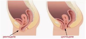 Препараты для лечения цистоцеле