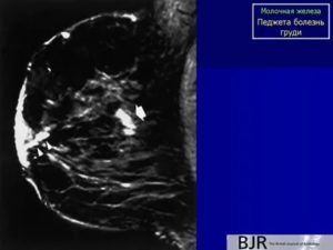 Рак соска молочной железы болезнь педжета что это такое