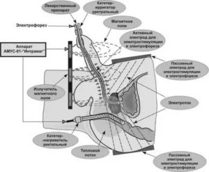 Электростимуляция простаты трансректальная отзывы