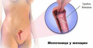 После лечения молочницы осталось жжение у мужчин