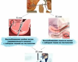 Гистероскопия биопсия эндометрия с гистологическим исследованием