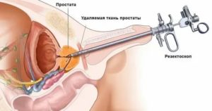 История болезни при аденоме простаты