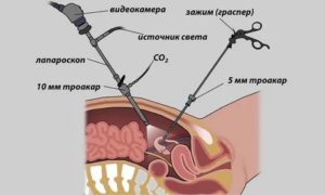 Кому лапароскопию делали перед месячными