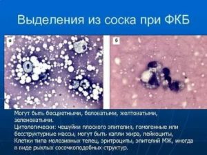 Чешуйки плоского эпителия в мазке на цитологию молочной железы