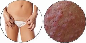 Мазь если чешется лобок