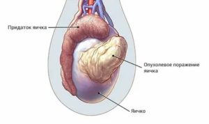 Опухоль как третье яичко что это может быть