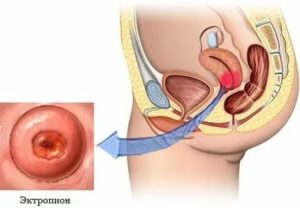 Диагностика выпадения шейки матки