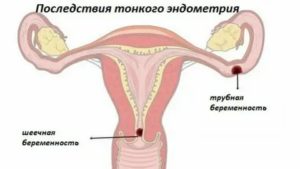 Тонкий эндометрий может ли быть причиной бесплодия