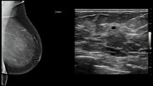 Трехмерное узи молочной железы
