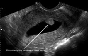 Фиброзные полипы в матке на узи