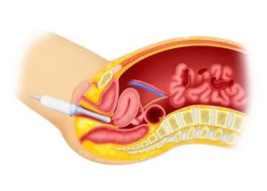 Влагалищное узи что это такое
