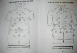 Точки для хиджамы от бесплодия для мужчин