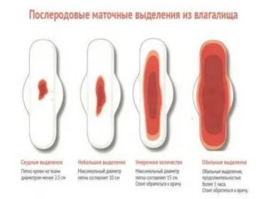 Что делать при обильных месячных со сгустками после кесарева