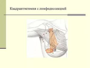 Лимфодиссекция при раке молочной железы это