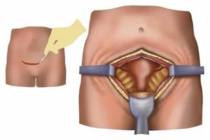 Удаление сальника при раке яичников последствия