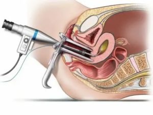 После гистероскопии полипа эндометрия когда можно беременеть отзывы