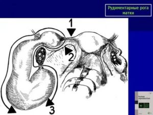 Рудиментарный рог матки по узи