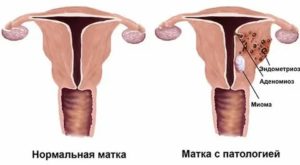 Эндометриоз аденомиоз миому полипы эндометрия