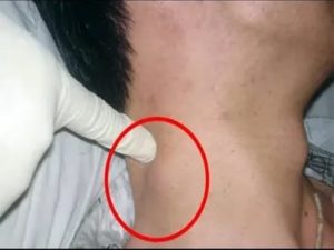 Могут ли воспаляться лимфоузлы при эндометриозе