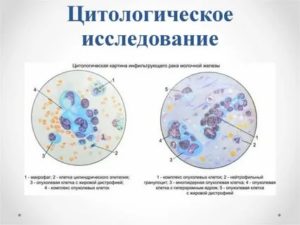 Что показывает цитология кисты молочной железы