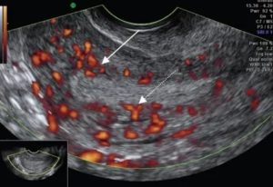 Что такое узи на доплер сосудов матки