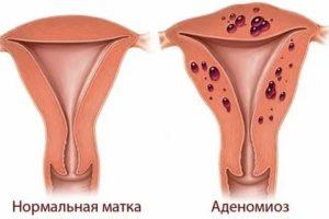 Можно ли забеременеть с миомой или эндометриозом