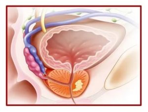 Хронический простатиты википедия