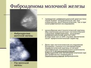 Лечение фиброаденомы молочной железы лекарственными препаратами