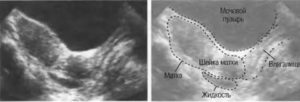 Жидкость в позадиматочном пространстве после овуляции на узи