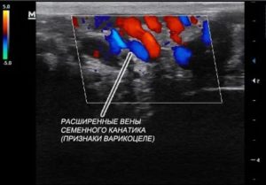 Узи мошонки с допплеровским исследованием что это такое