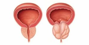 Аденома простаты анемия