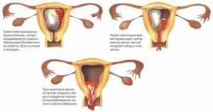 Когда наступают месячные после медикаментозного прерывания беременности