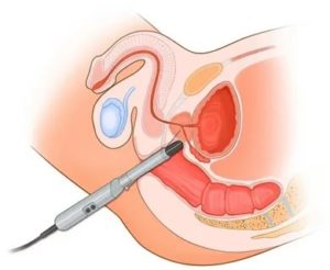 Что такое ректальный массаж при простатите