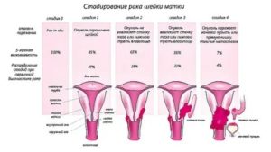 Повышение температуры при раке матки может быть