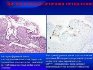 Клетки метаплазированного эпителия с реактивными изменениями. Метаплазия гистология. Метаплазия плоского эпителия. Плоскоклеточная метаплазия гистология. Метаплазия железистого эпителия.