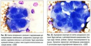 Чешуйки плоского эпителия в мазке на цитологию молочной железы