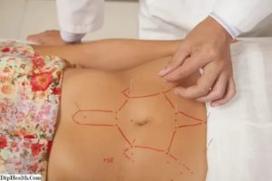 Можно ли делать иглоукалывание при эндометриозе