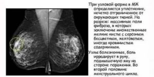 Что такое эхоскопически признаки фиброзно-кистозной мастопатии