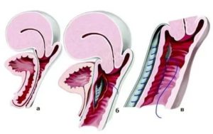 Препараты для лечения цистоцеле