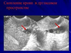 Жидкость за маткой при бесплодии