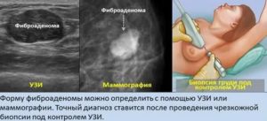 Фиброаденома молочной железы при климаксе