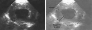 Жидкость в трубах матки на узи