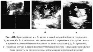Гипоплазия яичка что это такое узи