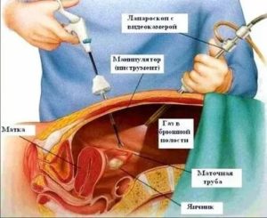 Для чего делается биопсия кисты яичника