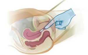 Введение препаратов во влагалище