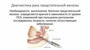 Чем опасно делать биопсию простаты