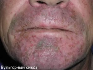 Пиодермии и кандидозов это