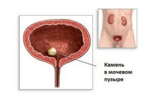 Боль в простате при семяиспускание у мужчин причины