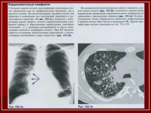 Раковый лимфангит при раке молочной железы